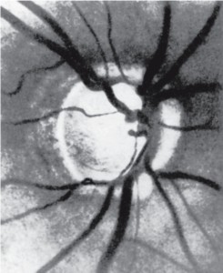 Нервная система и глаукома thumbnail